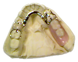 Cast Partial Dentures Work in delhi